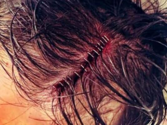 01-finn-balor-14-staples-02