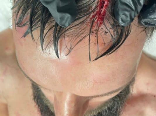 01-finn-balor-suffers-gruesome-cut-at-wrestlemania-39