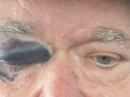 Jim Ross’ Eye Swollen Shut After Bad Fall, Update On AEW Collision Status